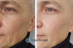 How to Fight Aging Symptoms 3 Fight Aging Symptoms Warminster With HIFU and Morpheus8 Today!