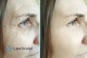 How to Fight Aging Symptoms 2 Do you want to Fight Aging Symptoms Warminster? Contact Lipo Sculpt today!