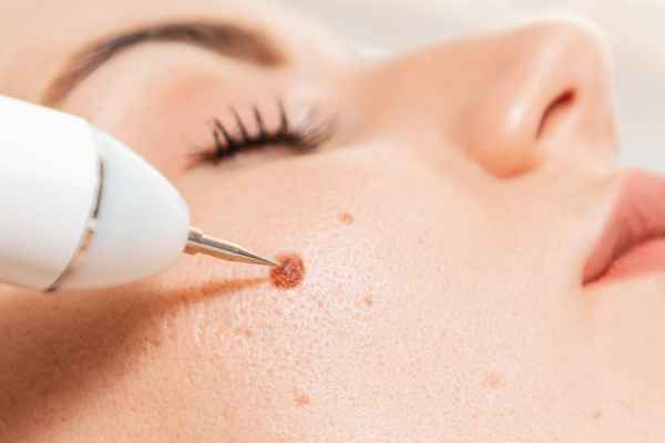 CryoPen: 5 Skin Concerns It May Be Used to Treat 3 What actually happens during a CryoPen treatment Warminster?